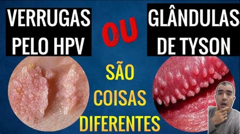 glandulas de tyson ou hpv|Glândulas de Tyson e HPV: conheça as diferenças